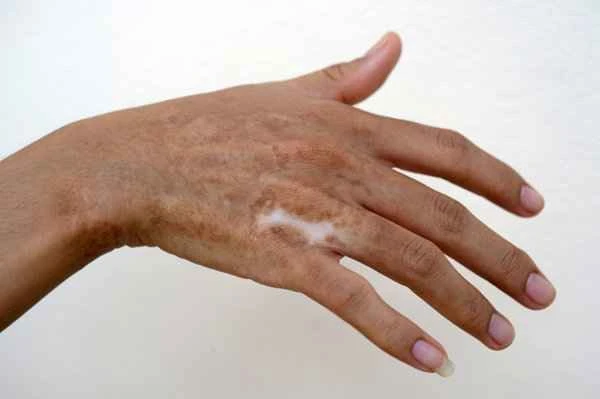 How to remove scars and lighten their color