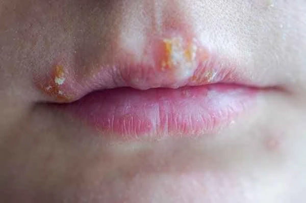 Can I use ointment for small blisters caused by cheilitis?