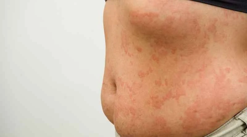 What ointment is most effective for papular urticaria?