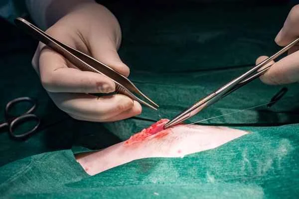 What is the best treatment for nasal root scars?