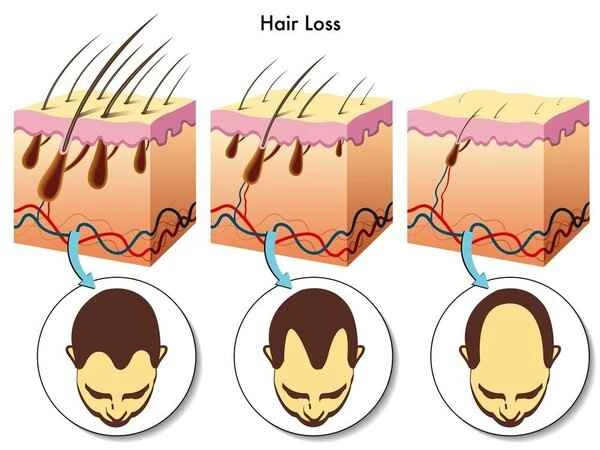 Abnormal keratinization of cells around hair follicles