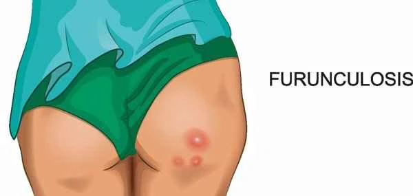 Painful hard lumps and scars after boils